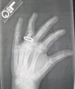 Tays finger.JPGe.jpg