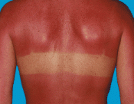 sunburn1.gif